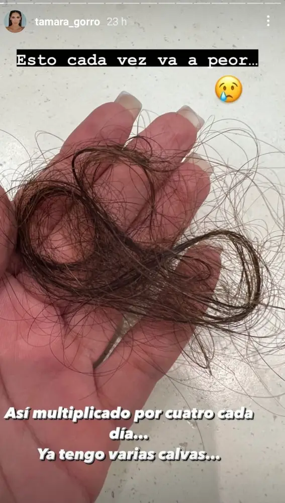 Tamara Gorro muestra los problemas de caída de pelo que sufre