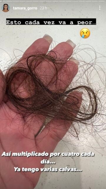 Tamara Gorro muestra los problemas de caída de pelo que sufre