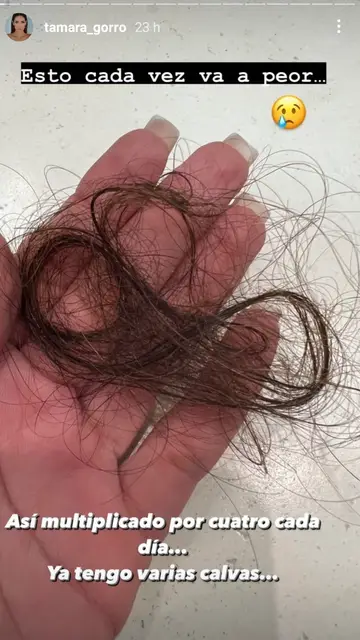 Tamara Gorro muestra los problemas de caída de pelo que sufre Tamara Gorro muestra los problemas de caída de pelo que sufre