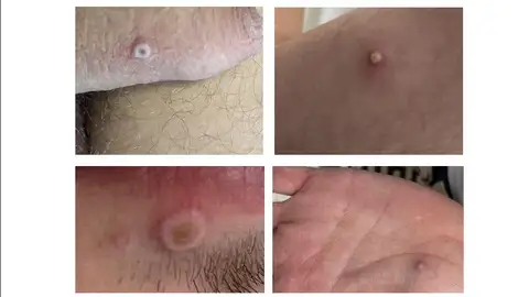 Viruela del mono Viruela del mono