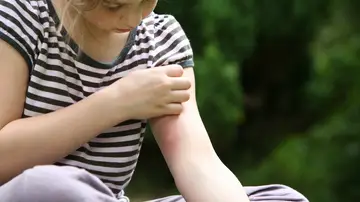 Una niña con una picadura de mosquito