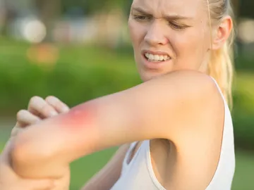Una joven con una picadura de mosquito Una joven con una picadura de mosquito