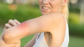 Una joven con una picadura de mosquito