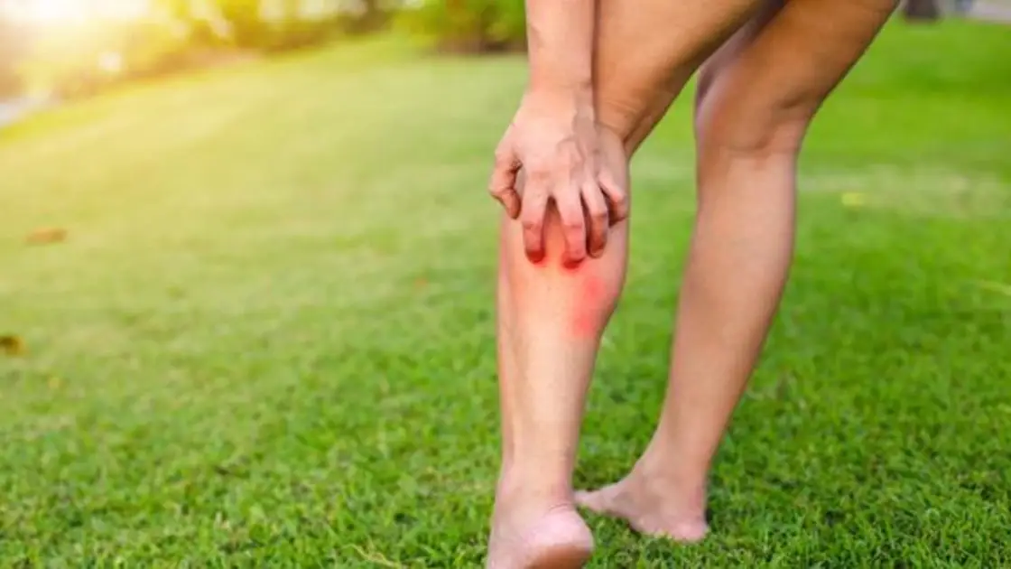 ¿Ola de calor? Los mejores trucos para ahuyentar a los mosquitos en el exterior Picaduras de mosquito
