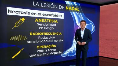 En qué consiste la radiofrecuencia pulsada o pulsátil, el tratamiento que usará Nadal en su pie izquierdo