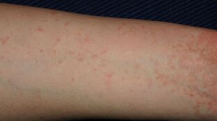Un brazo infectado con sarna