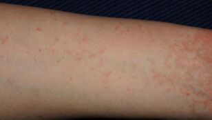 Un brazo infectado con sarna