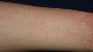 Un brazo infectado con sarna