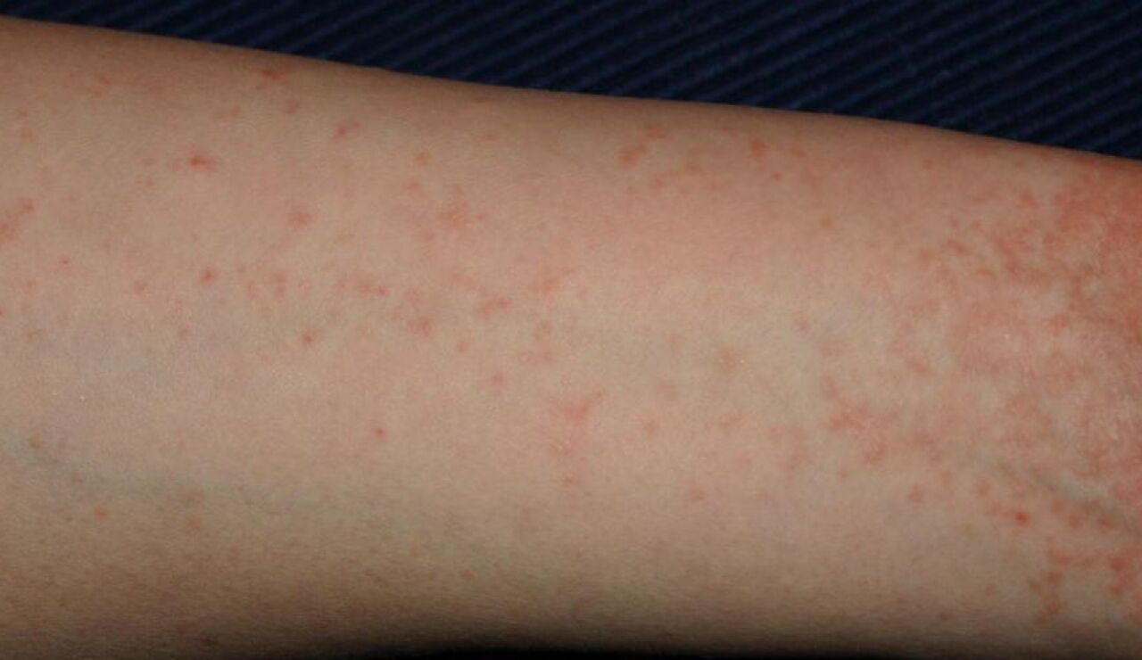 Un brazo infectado con sarna