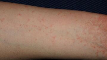 Un brazo infectado con sarna