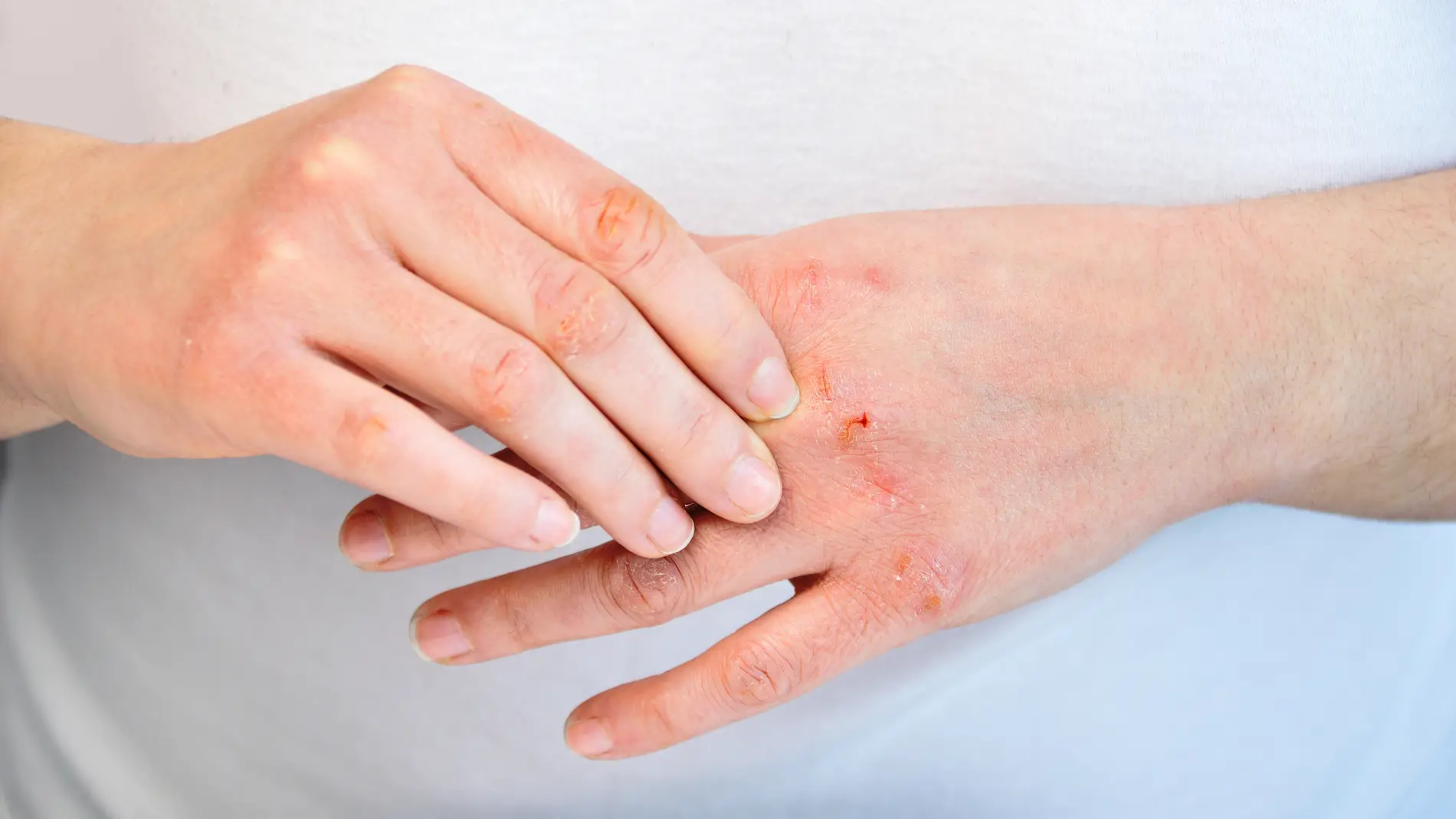 Dishidrosis