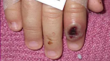 ¿Cómo se contagia la viruela del mono? ¿Cómo se contagia la viruela del mono?