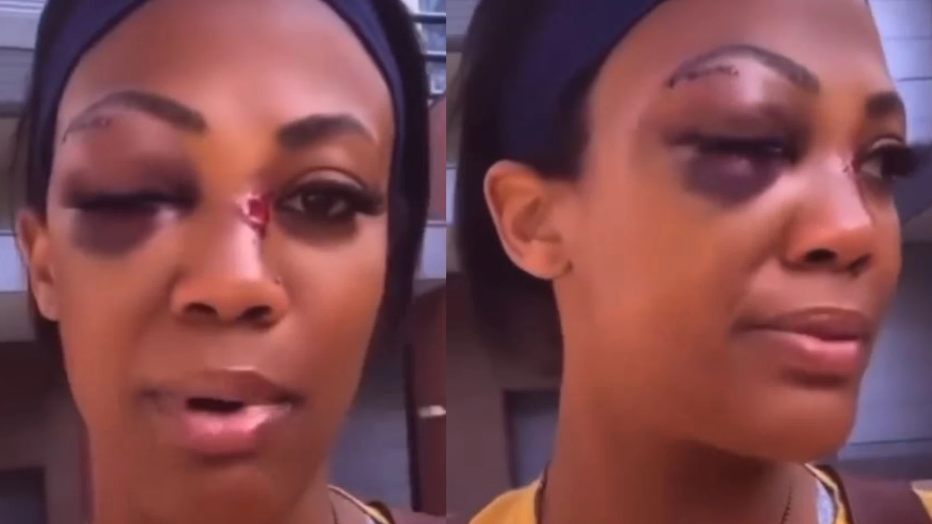 La medallista olímpica Kim Glass muestra sus heridas en la cara tras la escalofriante agresión de un vagabundo