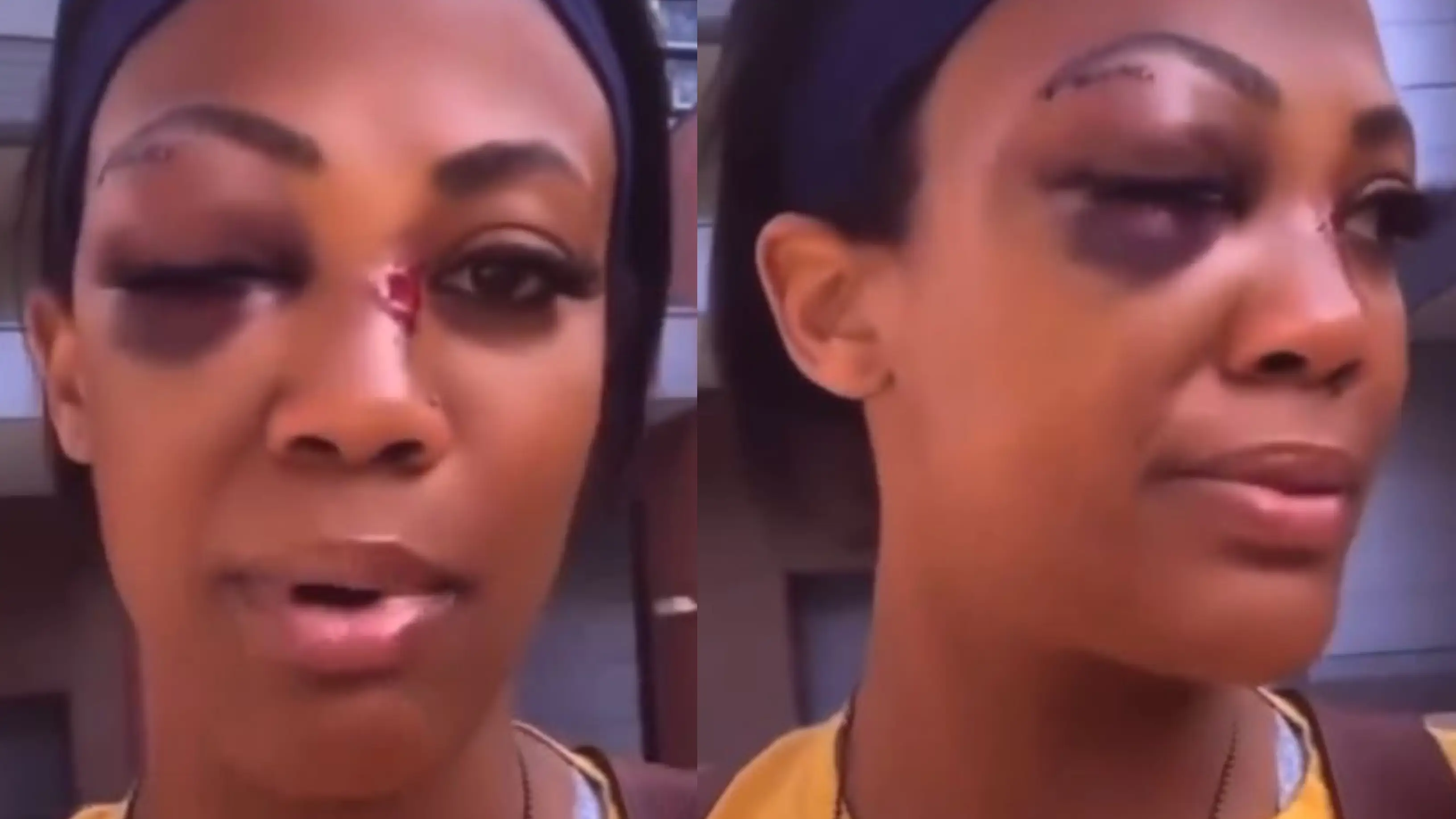 La medallista ol&iacute;mpica Kim Glass muestra sus heridas en la cara tras la escalofriante agresi&oacute;n de un vagabundo