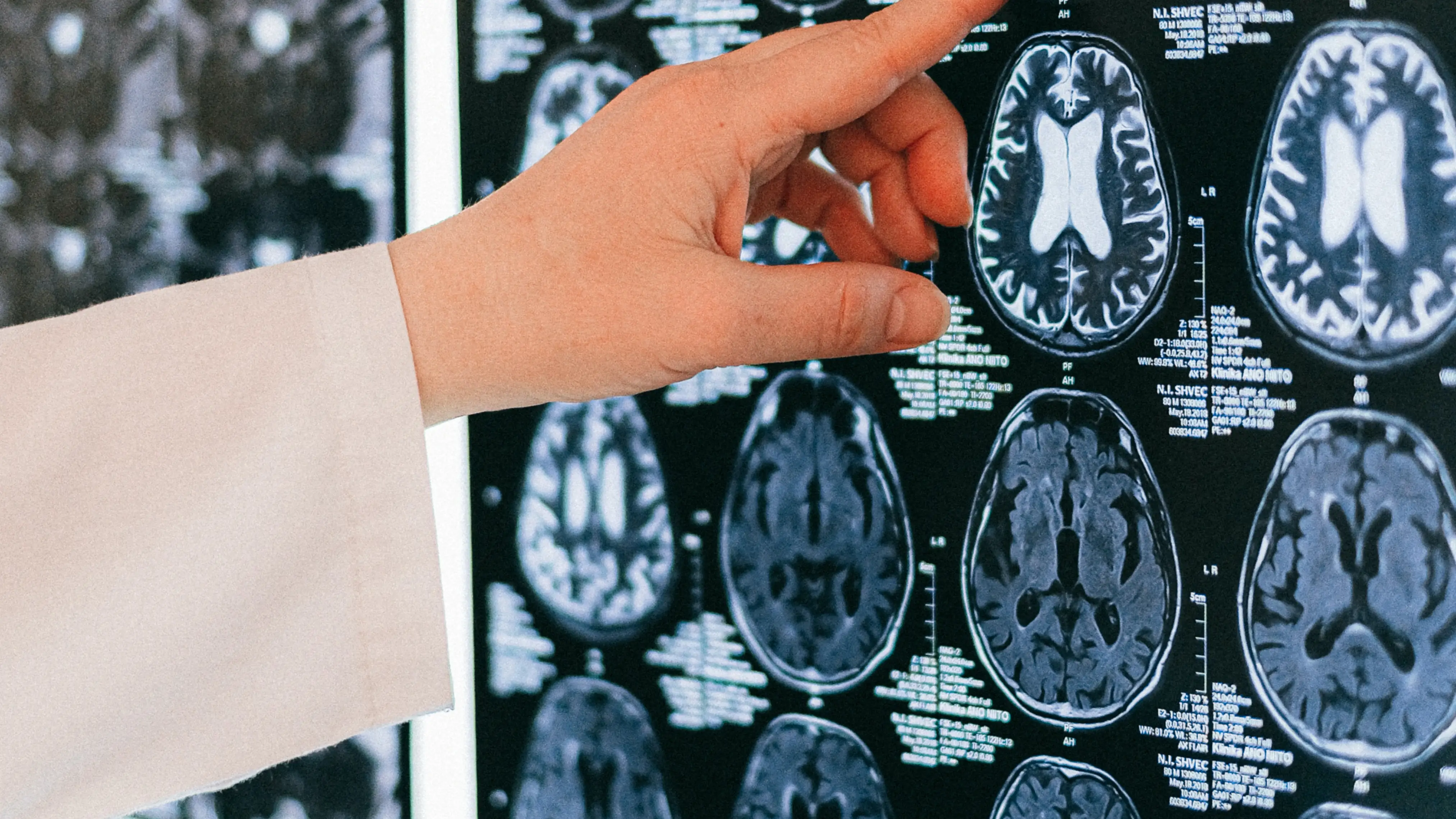 Una radiograf&iacute;a del cerebro humano