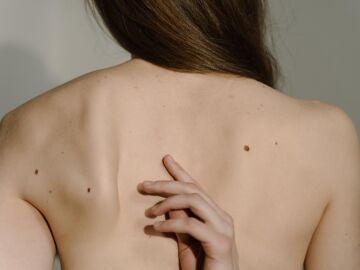 Mujer de espaldas que muestra sus lunares en la piel