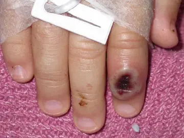 Imagen del Centro Estadounidense de Control de las Enfermedades (CDC) en la que se aprecia el dedo de un infectado por la viruela de mono