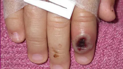 Imagen del Centro Estadounidense de Control de las Enfermedades (CDC) en la que se aprecia el dedo de un infectado por la viruela de mono Imagen del Centro Estadounidense de Control de las Enfermedades (CDC) en la que se aprecia el dedo de un infectado por la viruela de mono