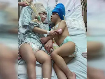 Dos gemelos siameses unidos por la cabeza son separados tras una operación en Brasil