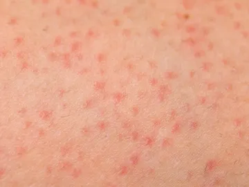 Sarpullido en la piel Sarpullido en la piel