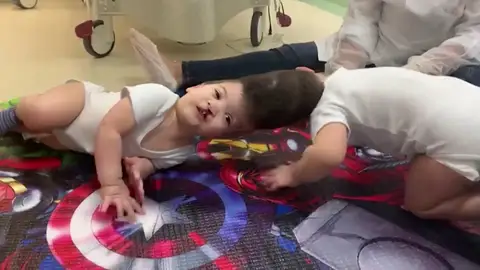 Imagen de los dos siameses que han nacido con la cabeza unida Siameses