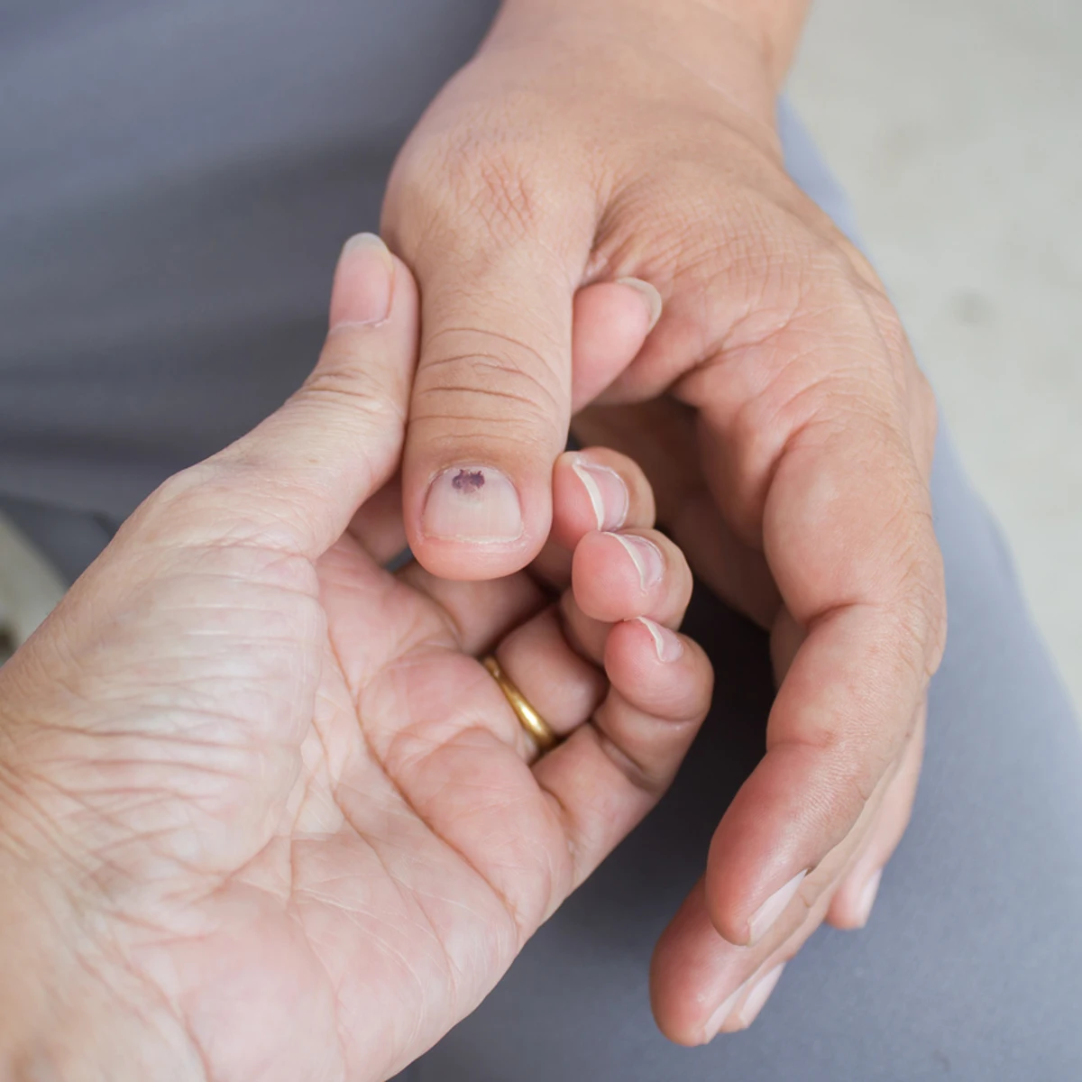 táctica bancarrota factible Hematoma, melanoma y onicomicosis: Cómo saber si las manchas de tus uñas  son peligrosas