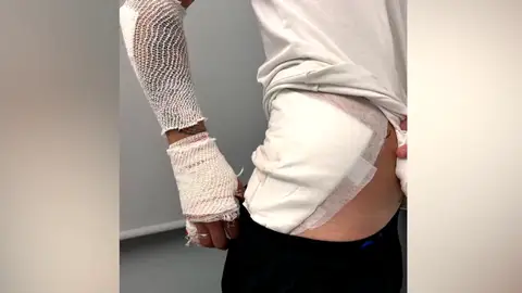 Quemaduras tras un accidente donde el conductor huyó Quemaduras tras un accidente donde el conductor huyó