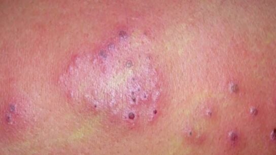 Herpes Z&oacute;ster