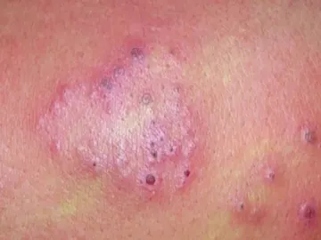 Herpes Zóster Herpes Zóster