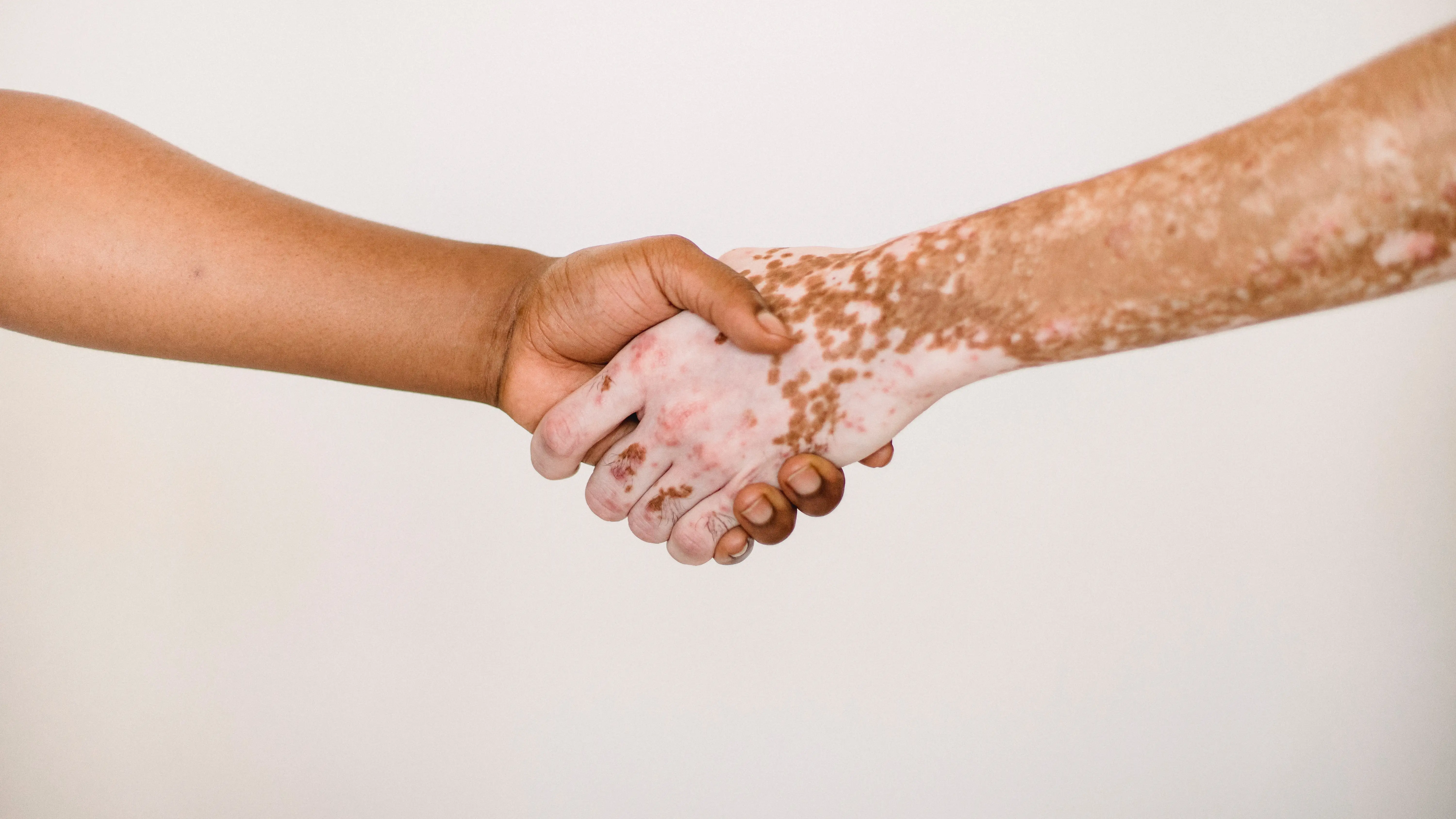 Imagen de archivo de psoriasis