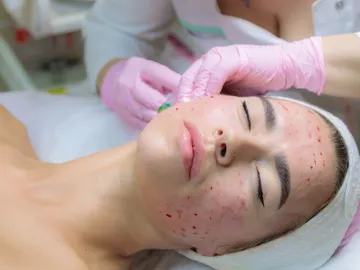 Vampire facial Vampire facial