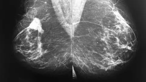 Mamografía Mamografía