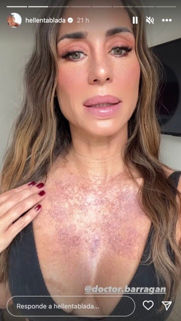 Elena Tablada muestra cómo tiene el escote tras su tratamiento