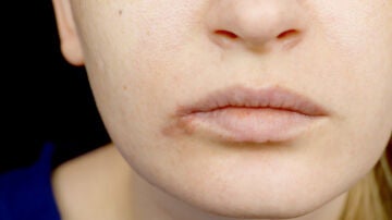 Boqueras: por qué aparecen y cómo tratarlas