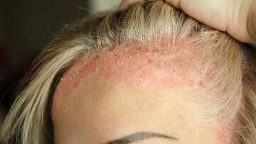 Plano detalle del nacimiento del pelo de una mujer con psoriasis en el cuero cabelludo