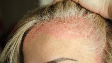  ¿Puedes usar maquillaje si tienes psoriasis?