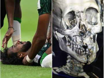 Impactante fractura de cráneo y mandíbula del jugador saudí tras el choque con su portero 