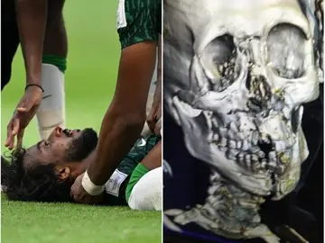 Impactante fractura de cráneo y mandíbula del jugador saudí tras el choque con su portero Impactante fractura de cráneo y mandíbula del jugador saudí tras el choque con su portero