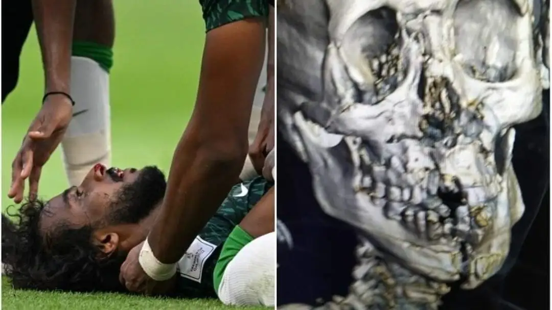Impactante fractura de cráneo y mandíbula del jugador saudí tras el choque con su portero Impactante fractura de cráneo y mandíbula del jugador saudí tras el choque con su portero