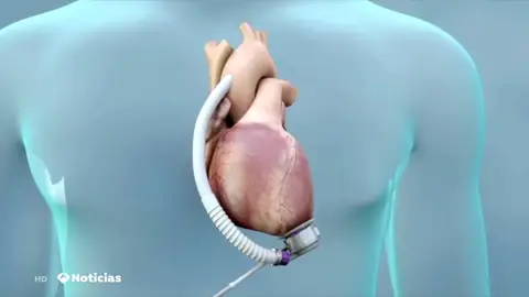 Más de 130 personas en España tienen un corazón mecánico instalado Más de 130 personas en España tienen un corazón mecánico instalado