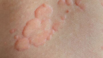 Primer plano de una pápula de liquen plano