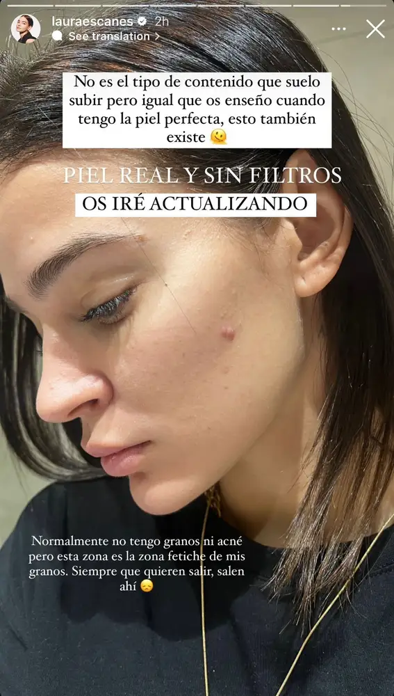 Laura Escanes muestra el acné de su rostro