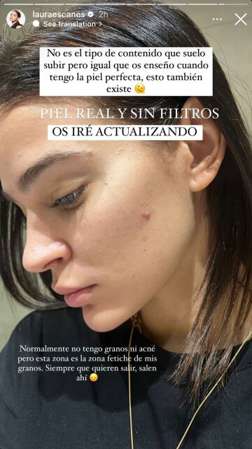 Laura Escanes muestra el acné de su rostro