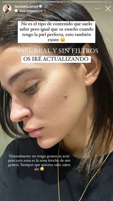 Laura Escanes muestra el acné de su rostro Laura Escanes muestra el acné de su rostro