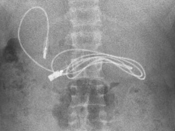 Radiografía del menor con el USB en el interior de su cuerpo