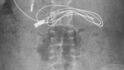 Radiograf&iacute;a del menor con el USB en el interior de su cuerpo