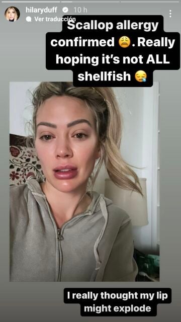 La reacción alérgica de Hilary Duff
