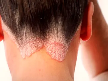 Brote de tiña en las peluquerías españolas: ¿Qué precauciones hay que tomar para evitar el contagio? Brote de tiña en las peluquerías españolas: ¿Qué precauciones hay que tomar para evitar el contagio?