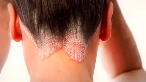 Brote de tiña en las peluquerías españolas: ¿Qué precauciones hay que tomar para evitar el contagio? Brote de tiña en las peluquerías españolas: ¿Qué precauciones hay que tomar para evitar el contagio?