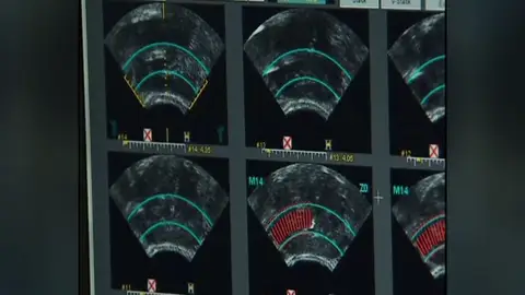 Terapia ultrasónica Terapia ultrasónica